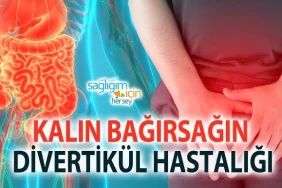 Divertikulit nedir