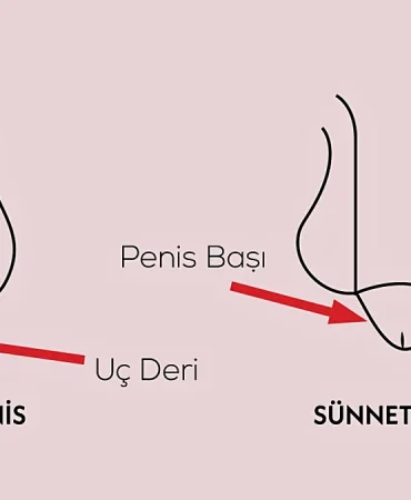 Sünnetin Faydaları ve Zararları Bilim Bu Konuda Ne Diyor? 3 Sunnetin-Faydalari-ve-Zararlari-Bilim-Bu-Konuda-Ne-Diyor