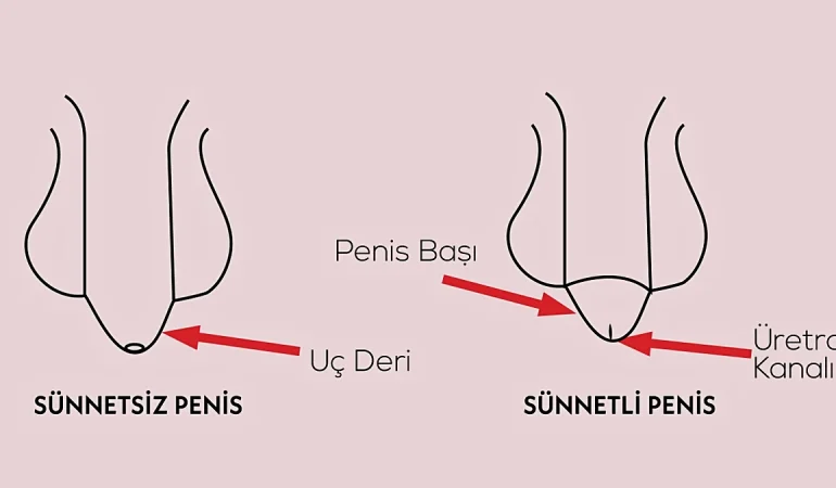 Sünnetin Faydaları ve Zararları Bilim Bu Konuda Ne Diyor?